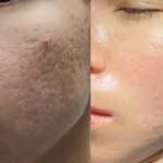 Scar Correction