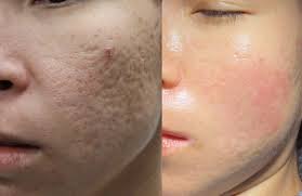 Scar Correction