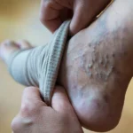 Varicose-Veins