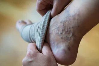 Varicose-Veins