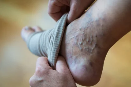 Varicose-Veins