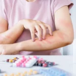 Drug Allergies