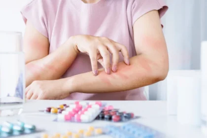 Drug Allergies
