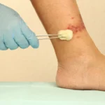 Venous Ulcers