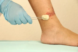 Venous Ulcers