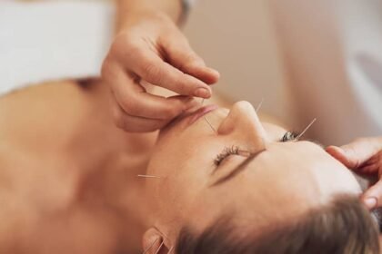 Acupuncture