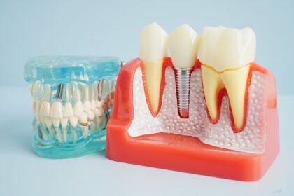 Benefits of Dental Implants