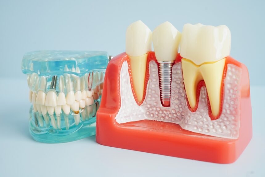 Benefits of Dental Implants