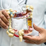 Colon Cancer
