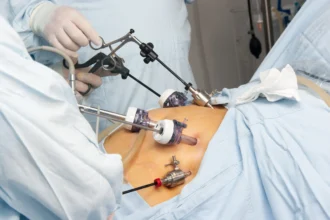 Gallbladder Removal Surgery