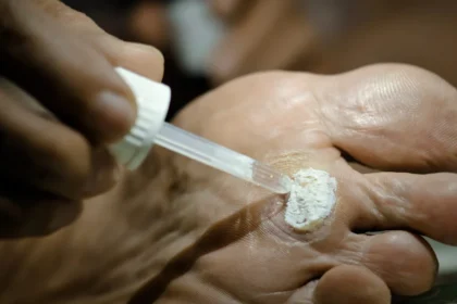 Plantar Warts